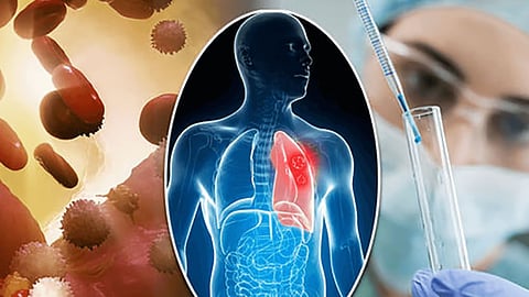 World Cancer Day: 93 new oral cancer patients in Bhandara, 152 new cases in one year; tobacco is a major cause