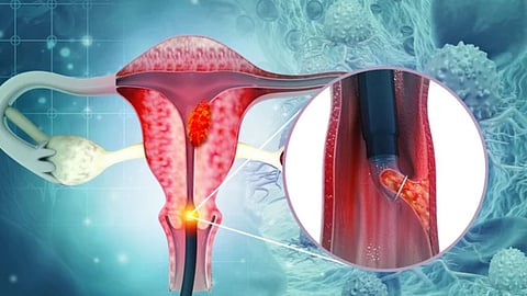 PMC launches 'Cervical Cancer Free Pune' campaign, providing free HPV vaccines to girls aged 9-13. Pune becomes India's first civic body to initiate this large-scale drive.