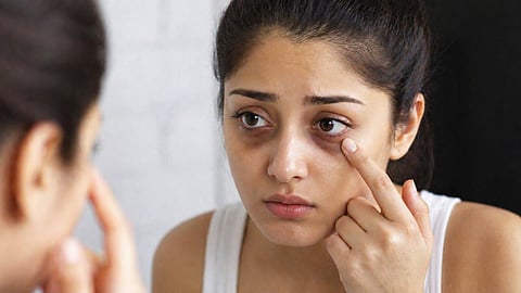 Dark Circles Causes
