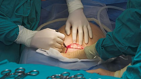 Why are cesarean deliveries on the rise? In this state, 90% of deliveries are by operation. Learn the reason.