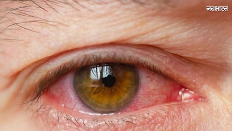 Mumbai Health Alert: 'Pink eye' terror in Mumbai, heat and pollution increase risk of eye infection
