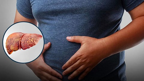 How To Reduce Fatty Liver Naturally