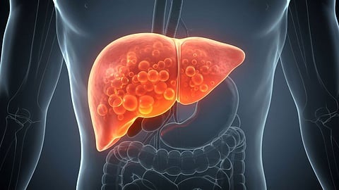 Fatty Liver solution, prevention from fatty liver, black coffee is good for fatty liver