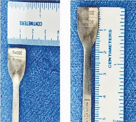An abdominal X-ray quickly pinpointed the spoon lodged near the duodenum.