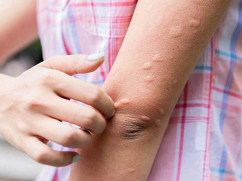 Surge in Japanese Encephalitis Cases: Vaccine Drive in Hyderabad