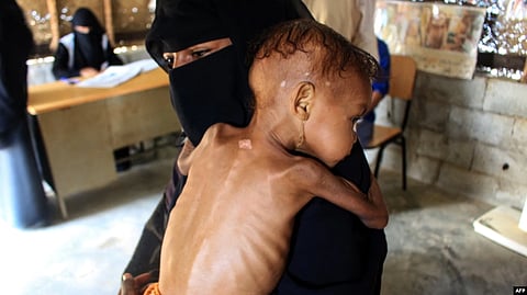 Randa, a Yemeni baby suffering from severe malnutrition, is carried by her mother as she awaits treatment at a center run by a humanitarian organization, inside a camp for the displaced, in the Abs district of Hajjah province, Dec. 21, 2021. (AFP via VOA)