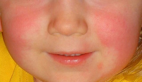 The effects of this fever are being observed only in children below 5 years of age.