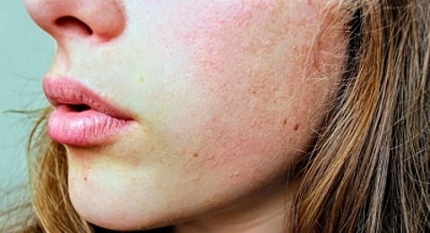 Chemical peels (IANS)