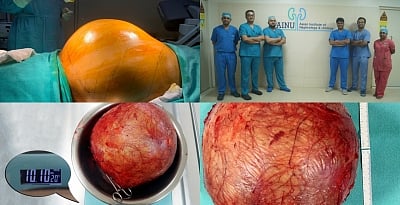 Doctors at Hyderabad hospital remove football-sized kidney tumour.