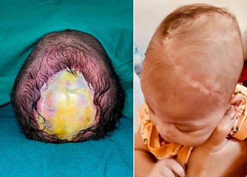 An infant boy, born with a rare skull defect, was successfully operated on - when five days old - to repair his skull and scalp at a Mumbai hospital. (IANS)