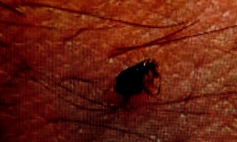 Indian researchers find antibiotic combo best for severe scrub typhus. (IANS)