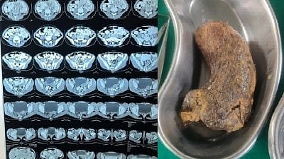 The medical team carried out a two-hour surgery to remove the hairball from minor girl Kiara's tummy.