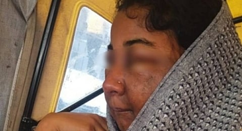 The victim, whose marriage was fixed, got her makeup done in the Gangashri Herbal Beauty Parlour and Spa of the town 10 days ago. However, after the makeup, the victim's face turned swollen, ugly, and disfigured. (IANS)