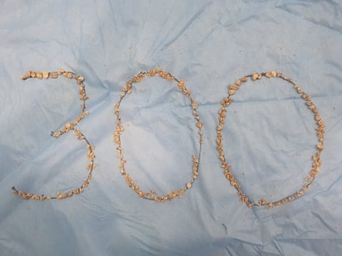 300 kidney stones removed from 75-yr-old farmer. (IANS)