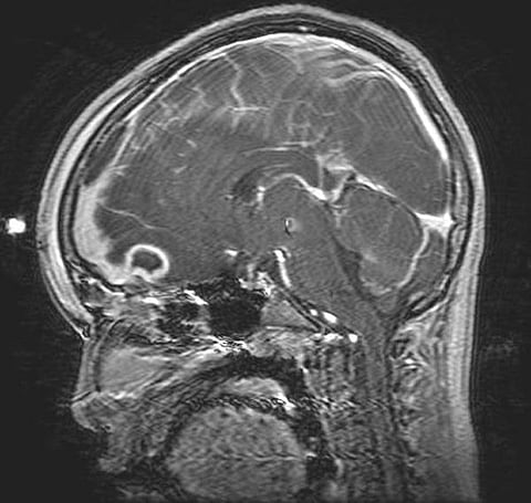 By spreading awareness about the signs, symptoms, world brain tumor day helps in early detection and timely intervention. (Wikimedia Commons)