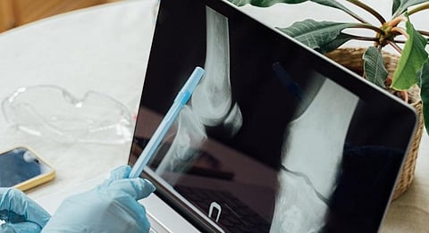 Calcium and vitamin D are essential for bone health: Adequate calcium and vitamin D intake are important for maintaining strong bones. (IANS)