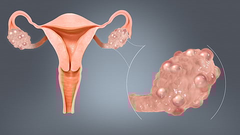 The risk in general was more than double for a type of ovarian tumour known as serous borderline among PCOS patients. (Wikimedia Commons)