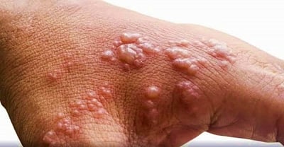 The villagers have been infected with Smallpox since last three months. (IANS)