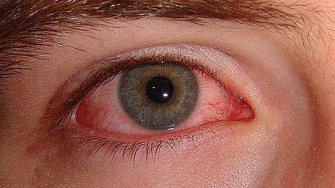 Doctors have warned people of taking over-the-counter (OTC) remedies, which could be harmful.
(Wikimedia Commons)
