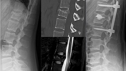Surgeons at KIMS Hospital, Kondapur, performed vertebral body stenting on a 65-year-old woman. (Wikimedia Commons)