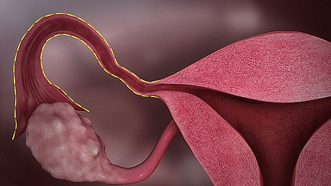 According to the study published in Nature Cancer journal, combining the personalised cancer vaccine with ACT yielded control of the disease within three months in 12 of 17 patients and the treatment was also found to be safe and relatively well tolerated. (Wikimedia commons)