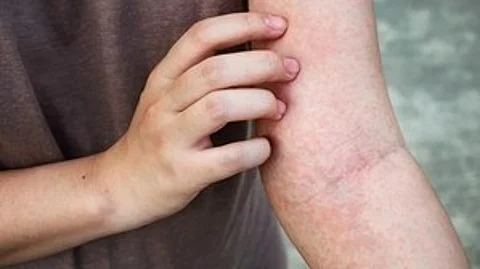 In such conditions, the equilibrium of microorganisms that keep our skin healthy is often thrown off balance, allowing S. aureus to flourish, said the researchers from Harvard Medical School (Wikimedia commons)