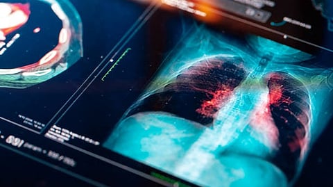 An image of a lung is shown on a computer screen, illustrating its anatomy for medical or educational reference.