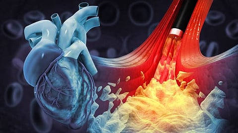 Illustration of a human heart with arteries showing blockage and blood flow restriction.