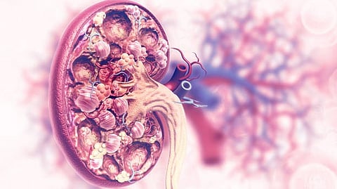 An anatomical illustration of a human kidney showing multiple kidney stones and the internal structure with blood vessels.