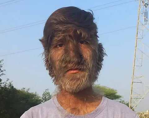 Image of an Indian teenager with Werewolf Syndrome