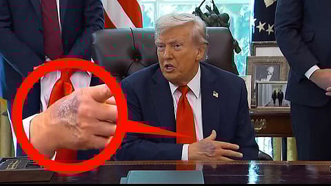 Trump's hand bruise spark health concerns among netizens