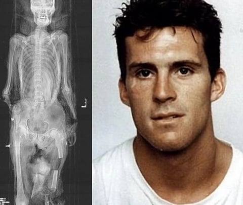 Right Image is of Duncan MacPherson and his x ray on the left with broken bones.