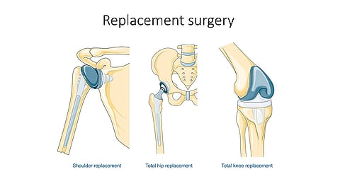 Diagram depicting shoulder, hip and knee replacement surgeries.