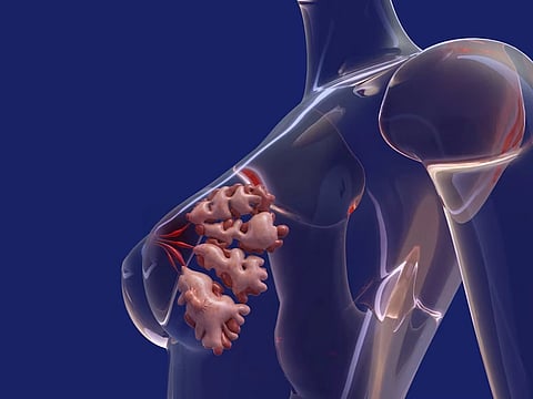 A graphic of breast cancer, with mammary glands highlighted.