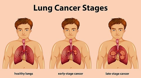 Illustration showing three stages of lung health: healthy lungs, early-stage cancer, and late-stage cancer, with lungs progressively deteriorating.
