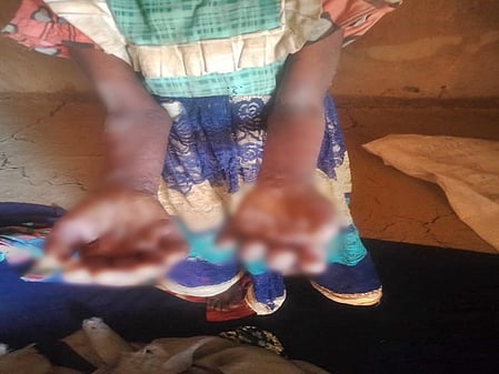 Digvijaya Singh flags skin disease outbreak among children in MP