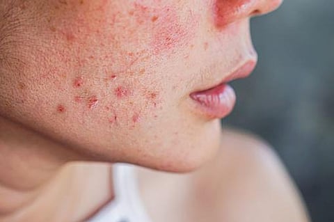 Discovery: 29 new acne risk genes influence skin condition
