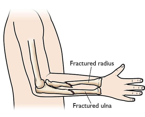 Forearm Fracture – Here’s What You Need To Know