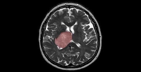 Common Parasite In Uncooked Food May Cause Brain Cancer