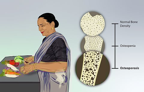 Inadequate Calcium And Vitamin D Intake Leads To Osteoporosis