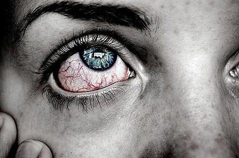 Toxic Air in Delhi Makes Eyes Irritable