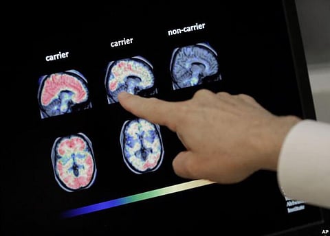 Three Indians Suffer from Brain Stroke Every Minute