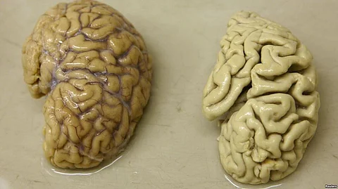 Alzheimer’s Linked To Improper Sleep In Elderly: Study