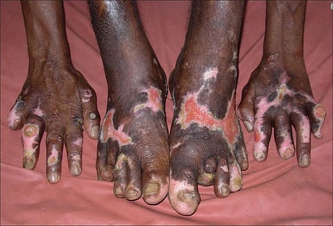 Study Identifies Brain Circuits That Cause Fatty Food Craving