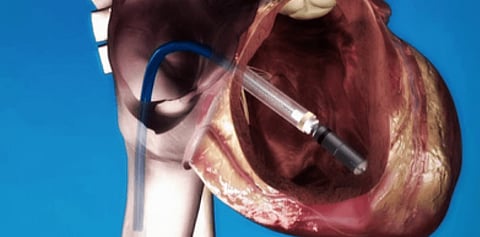 Free Angioplasty To Poor Patients Offered By Bengaluru Doctors