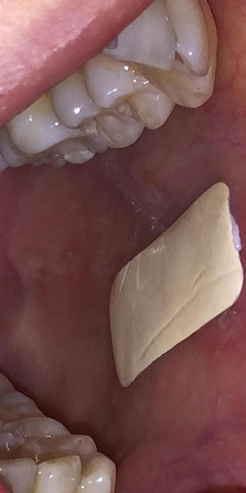 This Biodegradable Plaster can Treat Your Mouth Ulcers