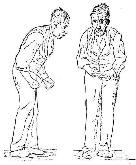 Testing Tears May Help In Early Diagnosis Of Parkinson’s Disease