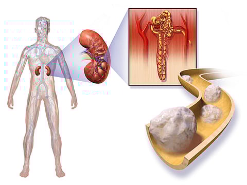 New Combo Therapy Found Effective In Kidney Cancer Patients