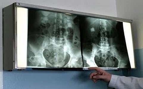 Kidney disease may increase the risk of Diabetes: says a study