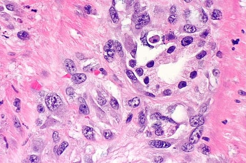 UN: Attacks Against Albinos for Body Parts, Stands Human Rights Issue